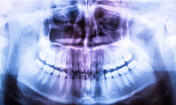 The Truth About Dental X-Rays