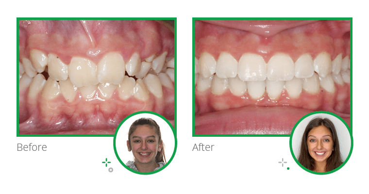 Before and after photos of Mason, a braces patient at TK Orthodontics