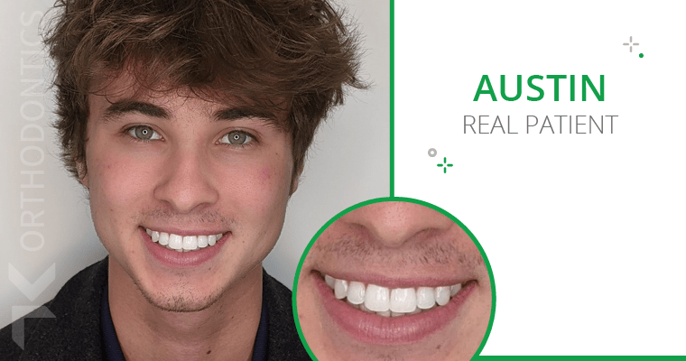 Why Austin Preferred Invisalign Over Braces (He Had Both!)